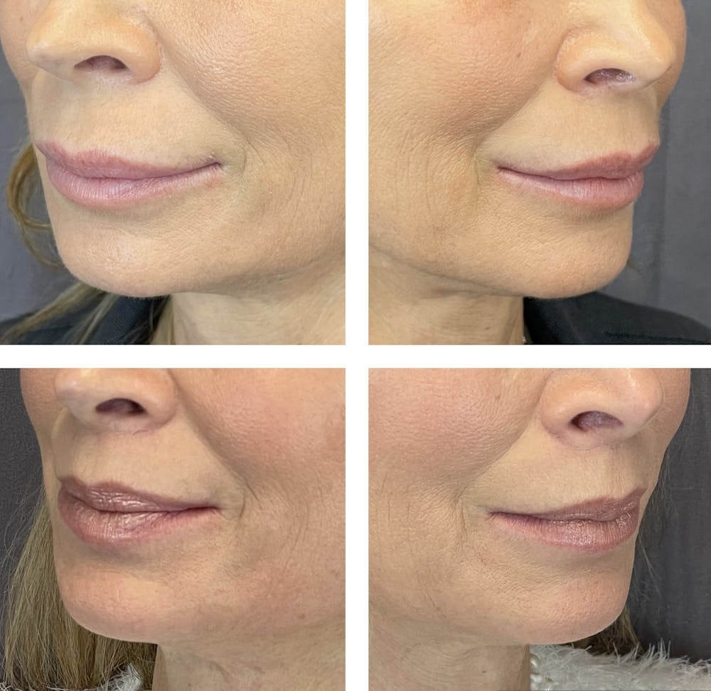 Lip Fillers Before & After Gallery - Patient 101181887 - Image 1