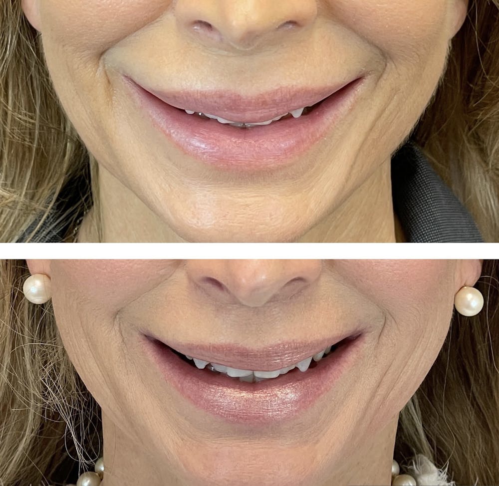 Lip Fillers Before & After Gallery - Patient 101181887 - Image 3