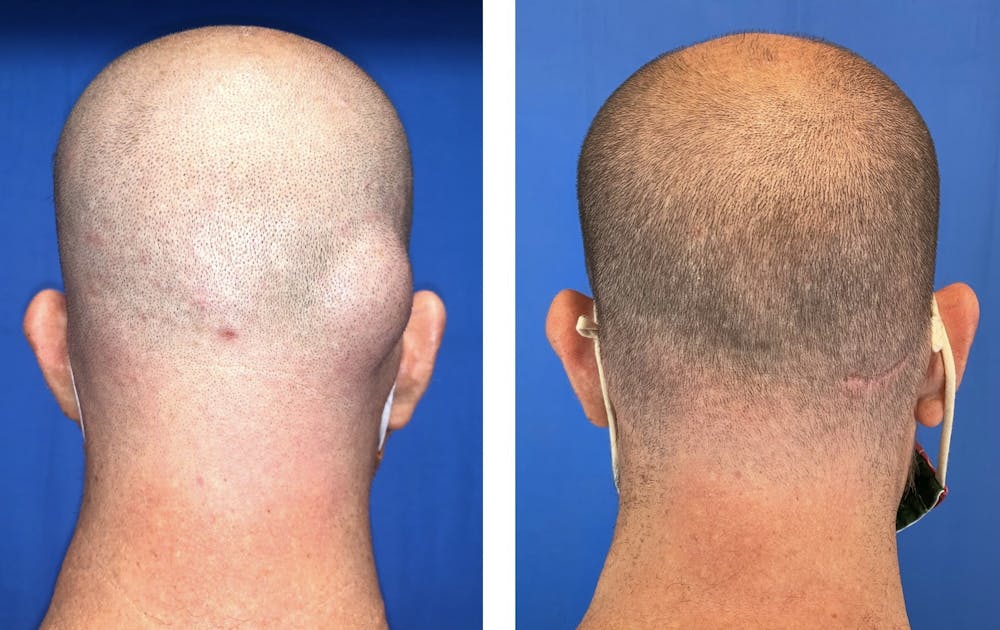 Lipoma Removal Before & After Gallery - Patient 101181892 - Image 2