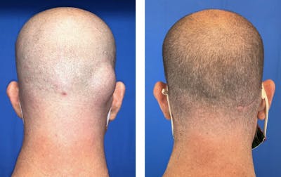 Lipoma Removal Before & After Gallery - Patient 101181892 - Image 2