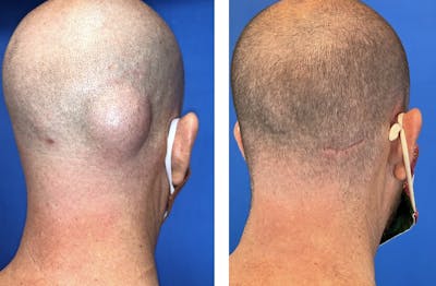 Lipoma Removal Before & After Gallery - Patient 101181892 - Image 1