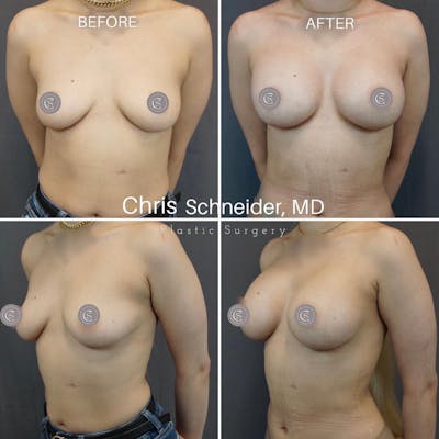 Breast Augmentation Before & After Gallery - Patient 102567459 - Image 1