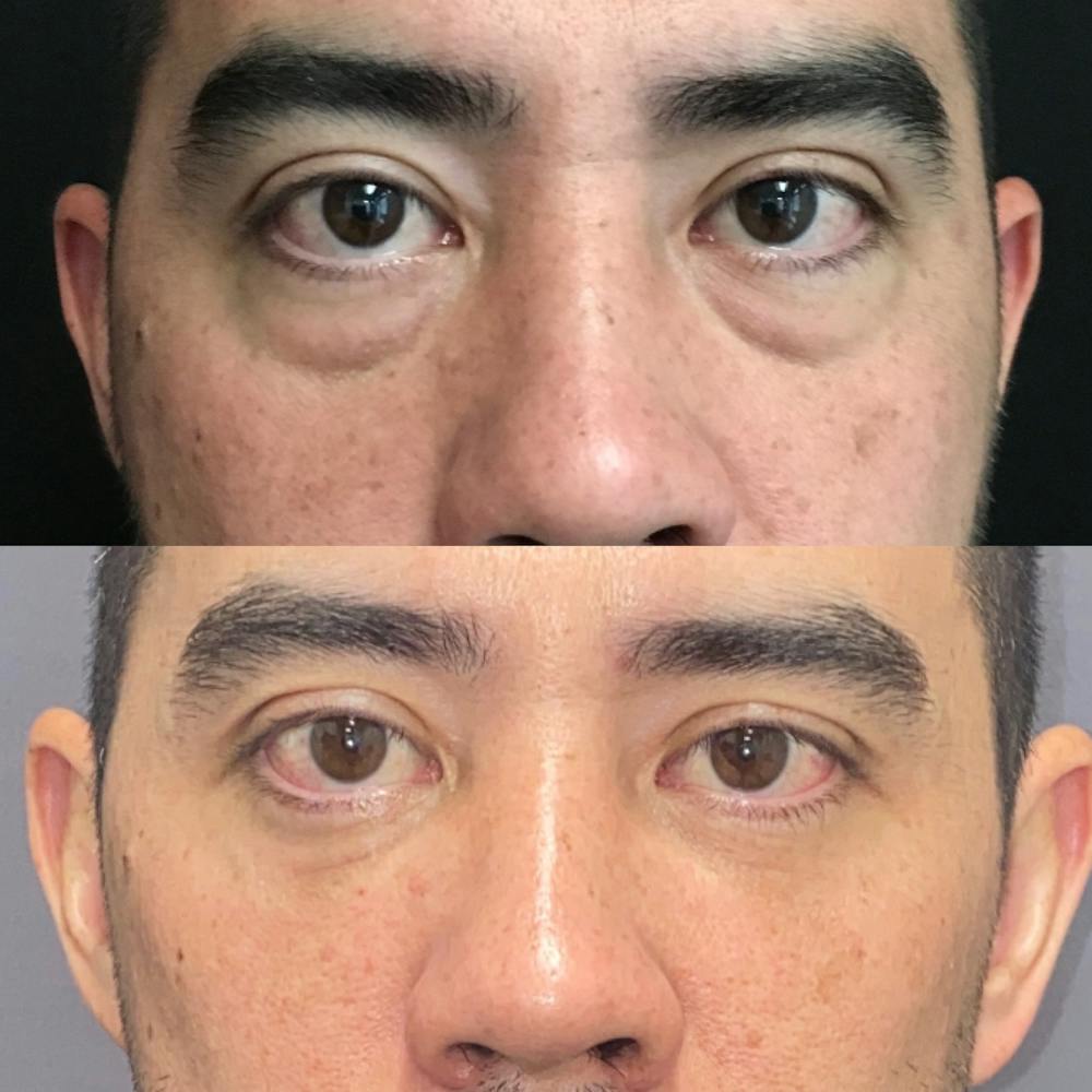 Lower Blepharoplasty Before & After Gallery - Patient 105878758 - Image 1