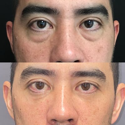 Lower Blepharoplasty Before & After Gallery - Patient 105878758 - Image 1