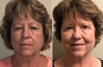 Brow Lift Before & After Gallery - Patient 108771466 - Image 1