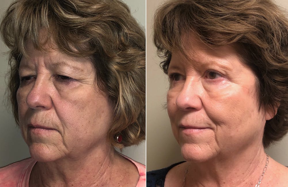 Upper Blepharoplasty Before & After Gallery - Patient 108771465 - Image 2