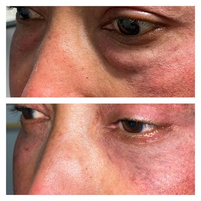 Lower Blepharoplasty Before & After Gallery - Patient 109084217 - Image 1