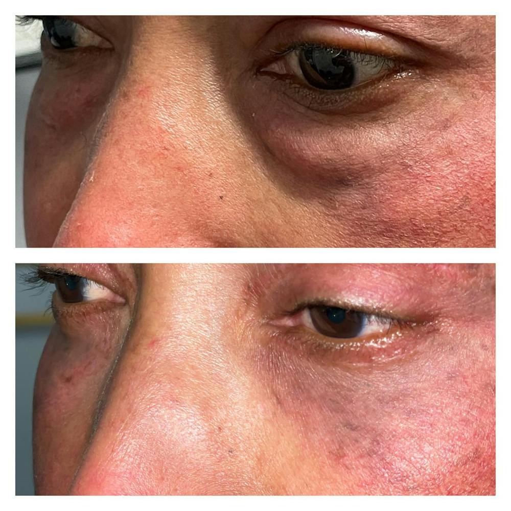 Lower Blepharoplasty Before & After Gallery - Patient 109084217 - Image 1