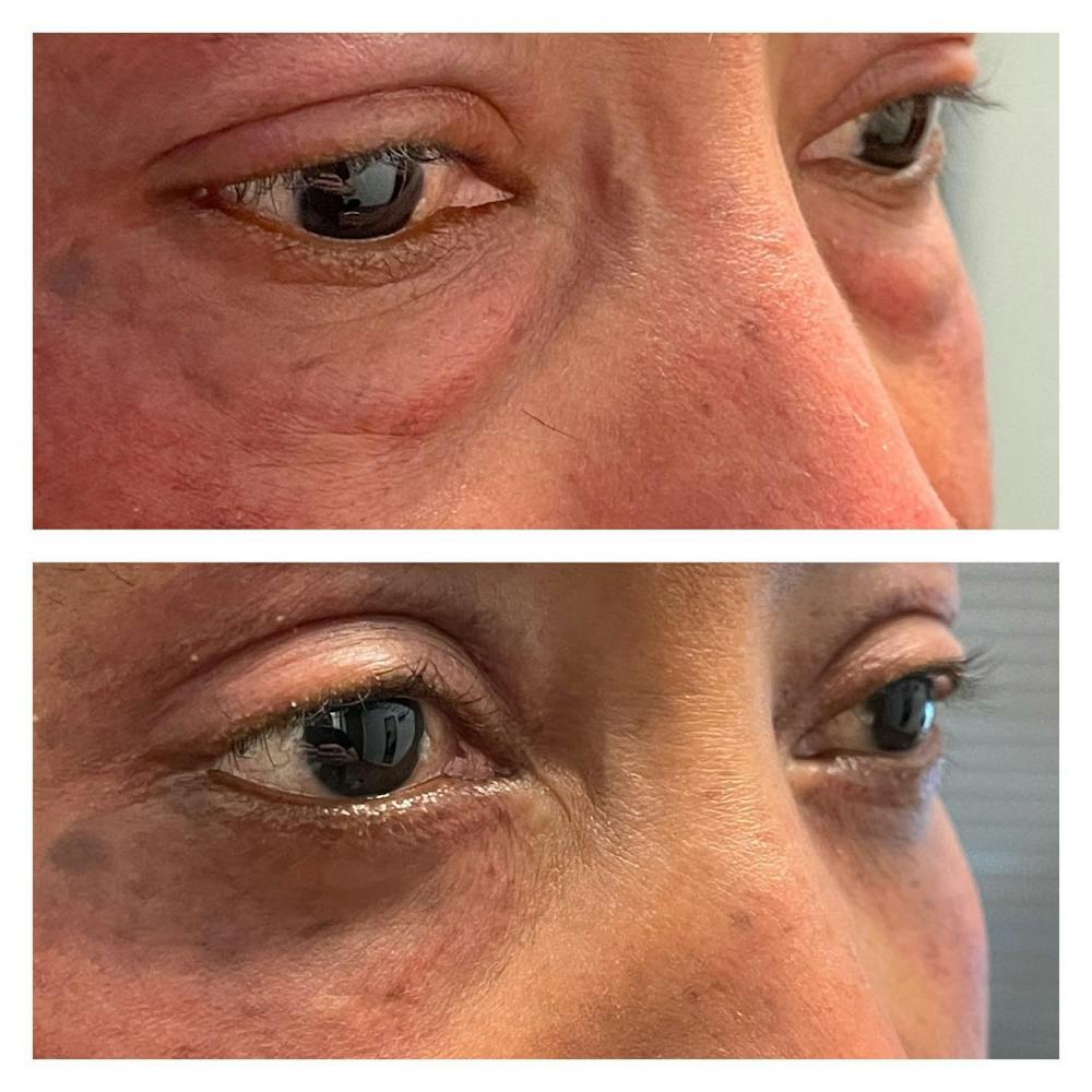 Lower Blepharoplasty Before & After Gallery - Patient 109084217 - Image 2