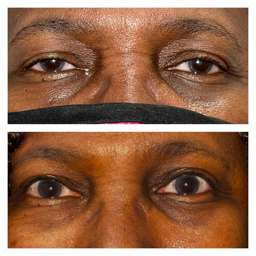 Eyelid Lift Before & After Gallery - Patient 109084234 - Image 1