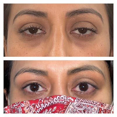 Ptosis Gallery - Patient 109084256 - Image 1
