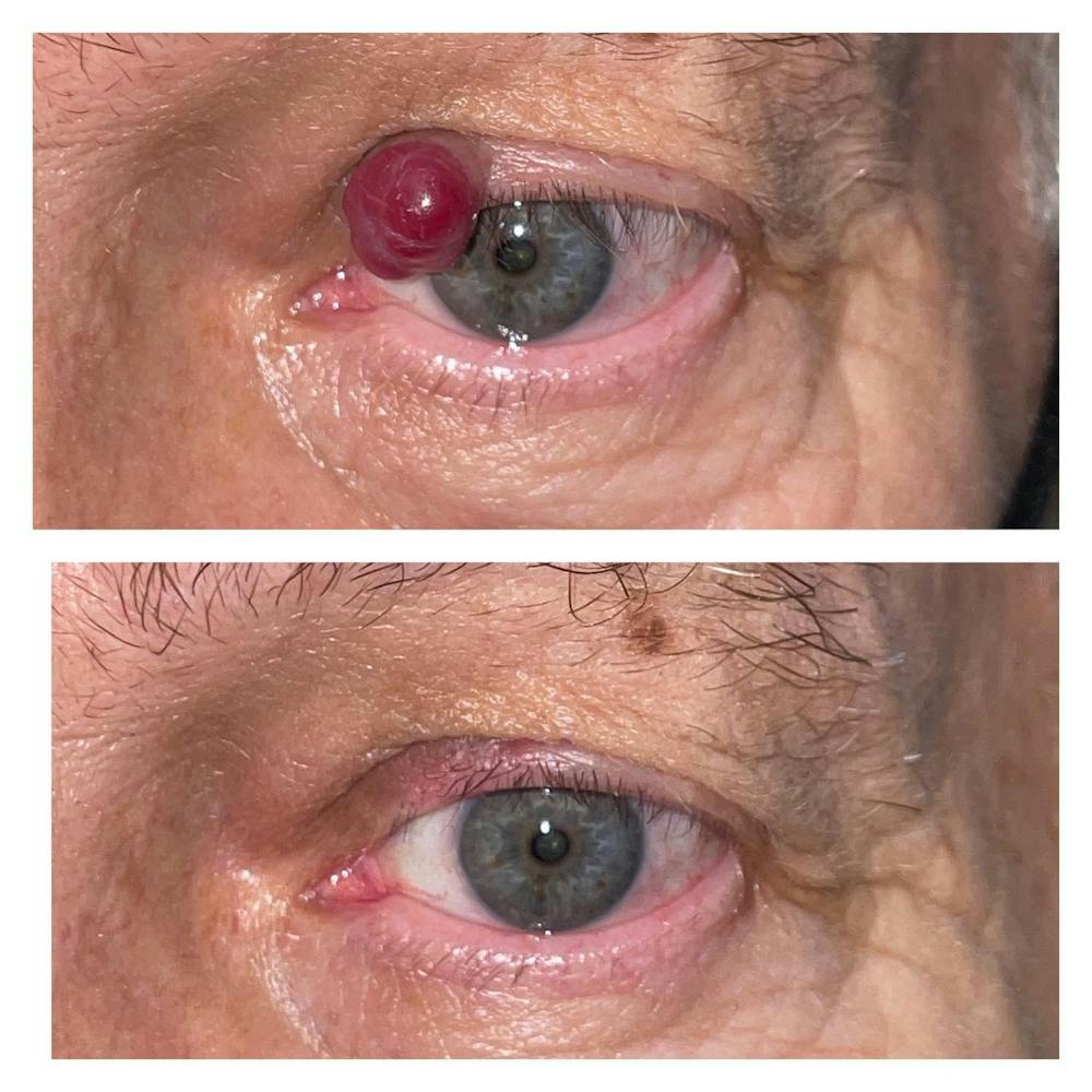 Lesions Before & After Gallery - Patient 109084264 - Image 1