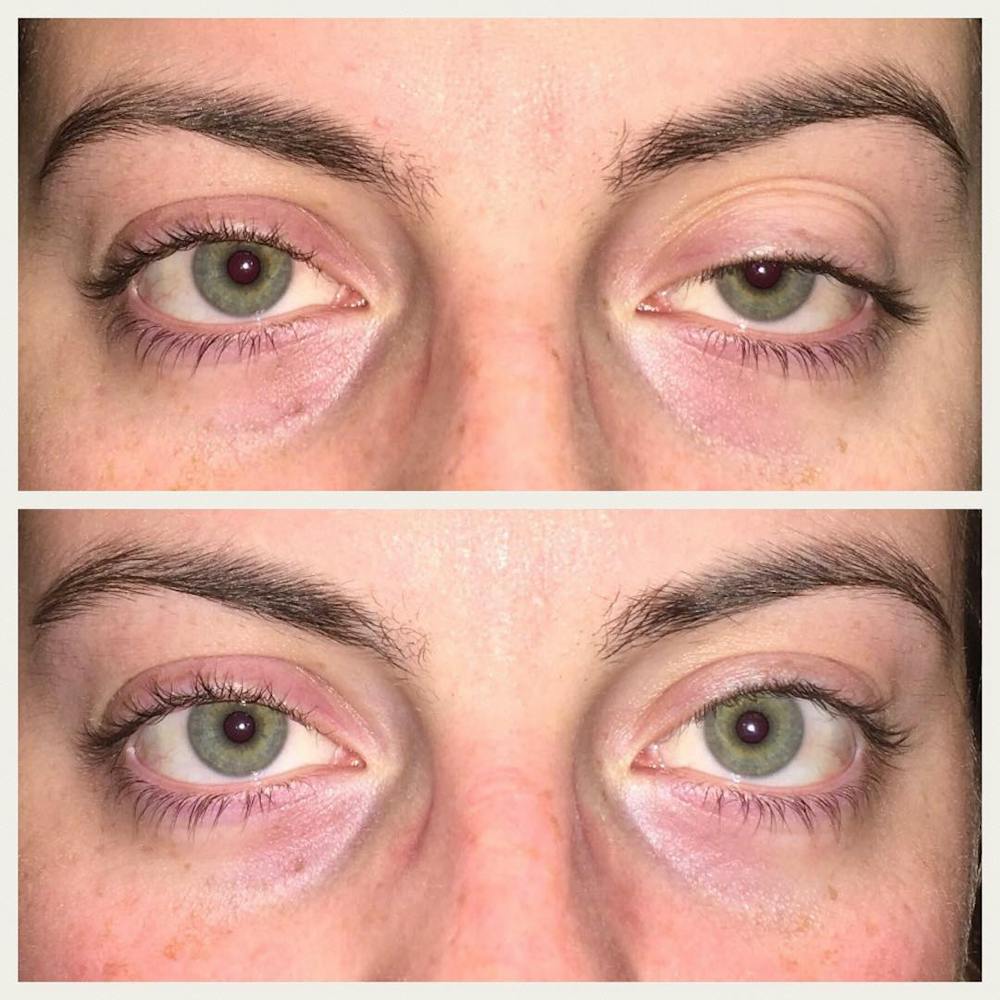 Ptosis Before & After Gallery - Patient 8523518 - Image 1