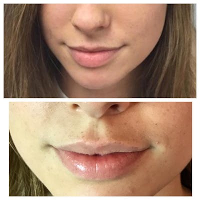 Lip Fillers Before & After Gallery - Patient 109084424 - Image 1