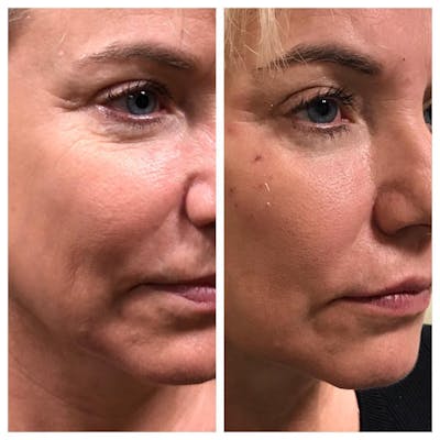 Dermal Fillers Before & After Gallery - Patient 109084430 - Image 1
