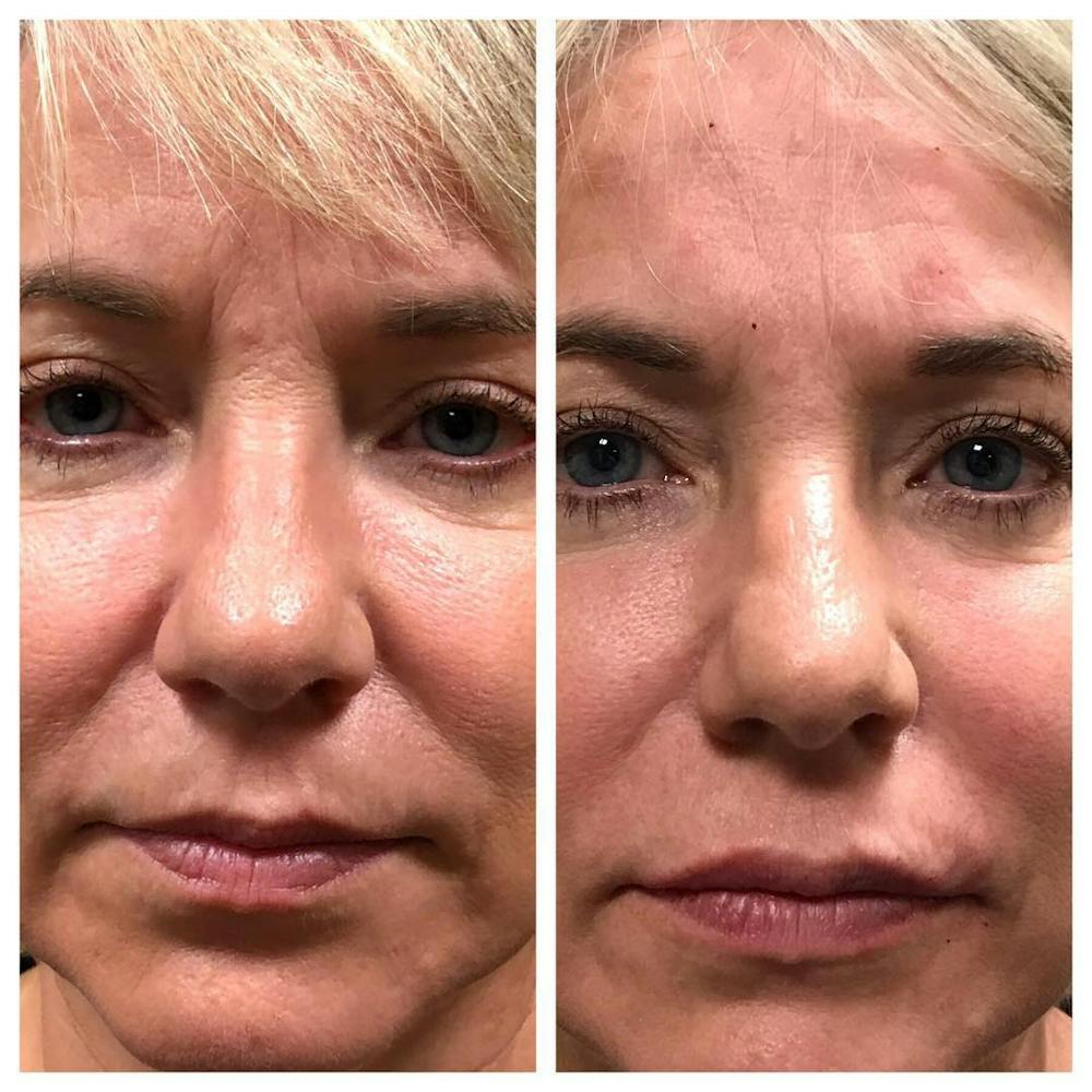 Dermal Fillers Before & After Gallery - Patient 109084430 - Image 2