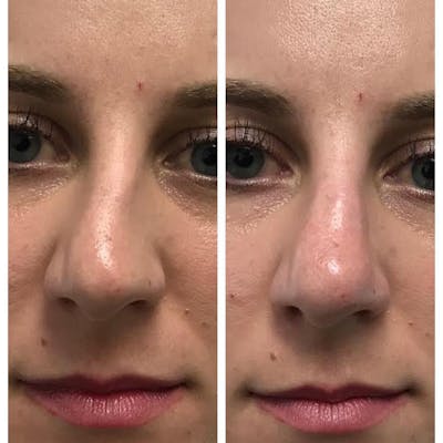 Non-Surgical Rhinoplasty Before & After Gallery - Patient 109084452 - Image 1
