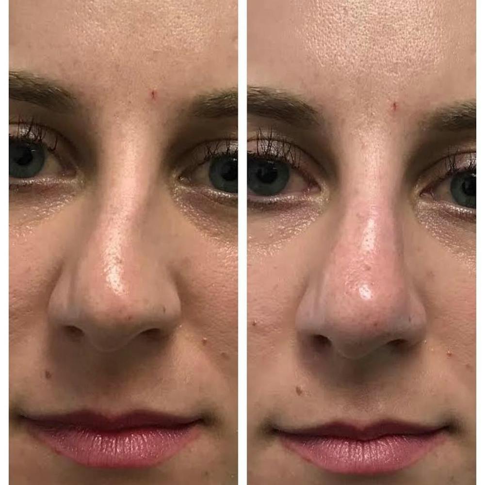 Non-Surgical Rhinoplasty Before & After Gallery - Patient 109084452 - Image 1