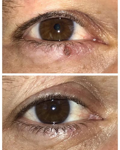 Lesions Before & After Gallery - Patient 109084464 - Image 1