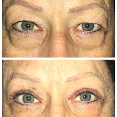 Upper Blepharoplasty Before & After Gallery - Patient 109084498 - Image 1