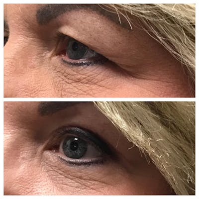 Upper Blepharoplasty Before & After Gallery - Patient 109084589 - Image 1