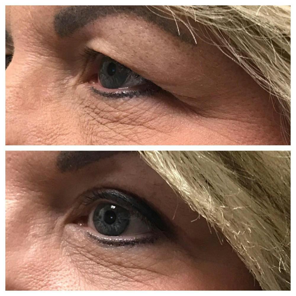Upper Blepharoplasty Before & After Gallery - Patient 109084589 - Image 1