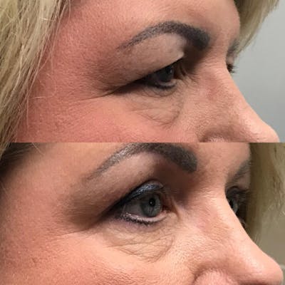 Upper Blepharoplasty Before & After Gallery - Patient 109084589 - Image 2