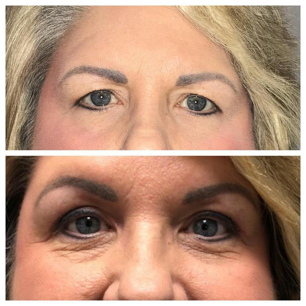 Upper Blepharoplasty Before & After Gallery - Patient 109084589 - Image 3