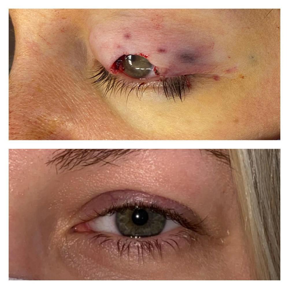 Eyelid Skin Cancer Removal (MOHS) Before & After Gallery - Patient 109084621 - Image 1