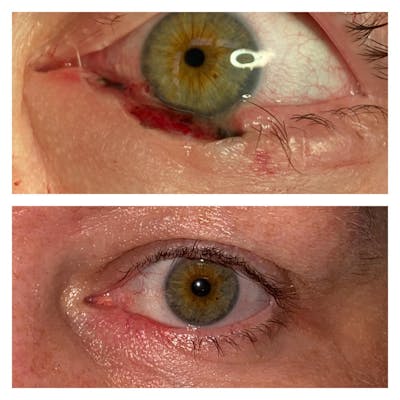Eyelid Skin Cancer Removal Before & After Gallery - Patient 109084622 - Image 1