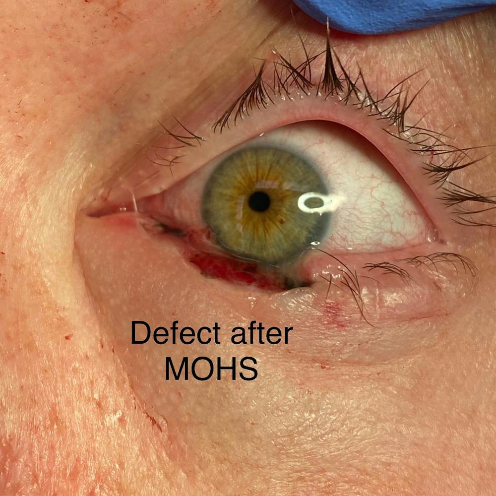 Eyelid Skin Cancer Removal (MOHS) Before & After Gallery - Patient 109084622 - Image 3