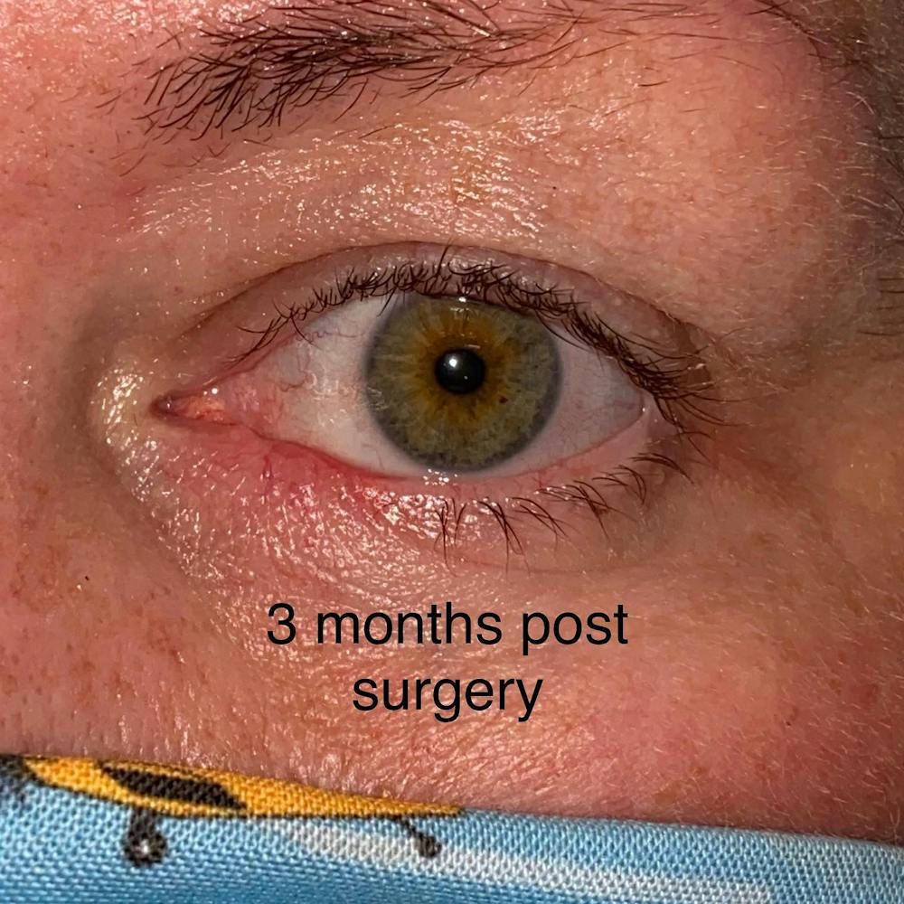 Eyelid Skin Cancer Removal (MOHS) Before & After Gallery - Patient 109084622 - Image 4
