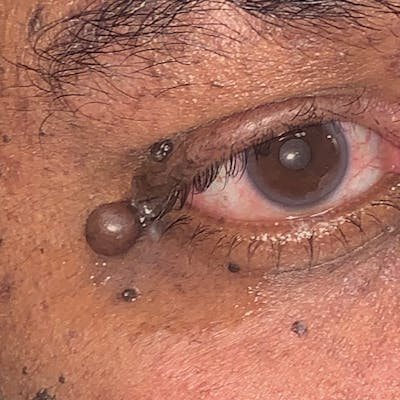 Lesions Before & After Gallery - Patient 109118944 - Image 1