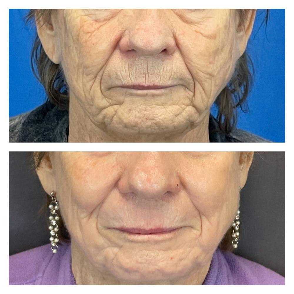Laser Resurfacing Before & After Gallery - Patient 111639093 - Image 1