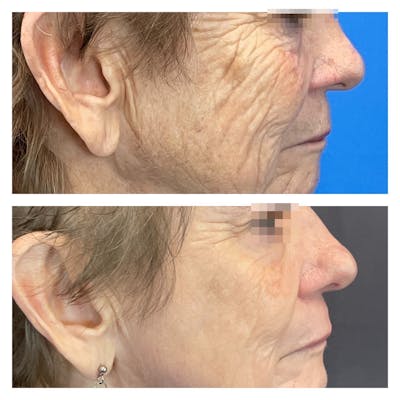 Laser Resurfacing Before & After Gallery - Patient 111639093 - Image 2