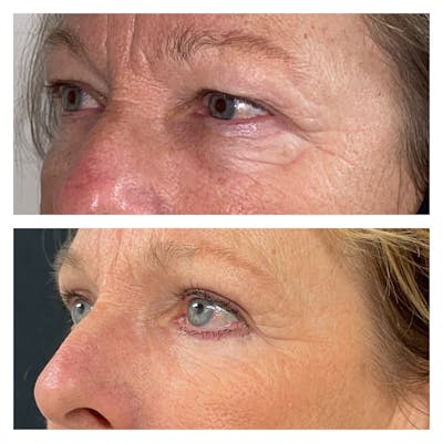 Laser Resurfacing Before & After Gallery - Patient 111639113 - Image 2
