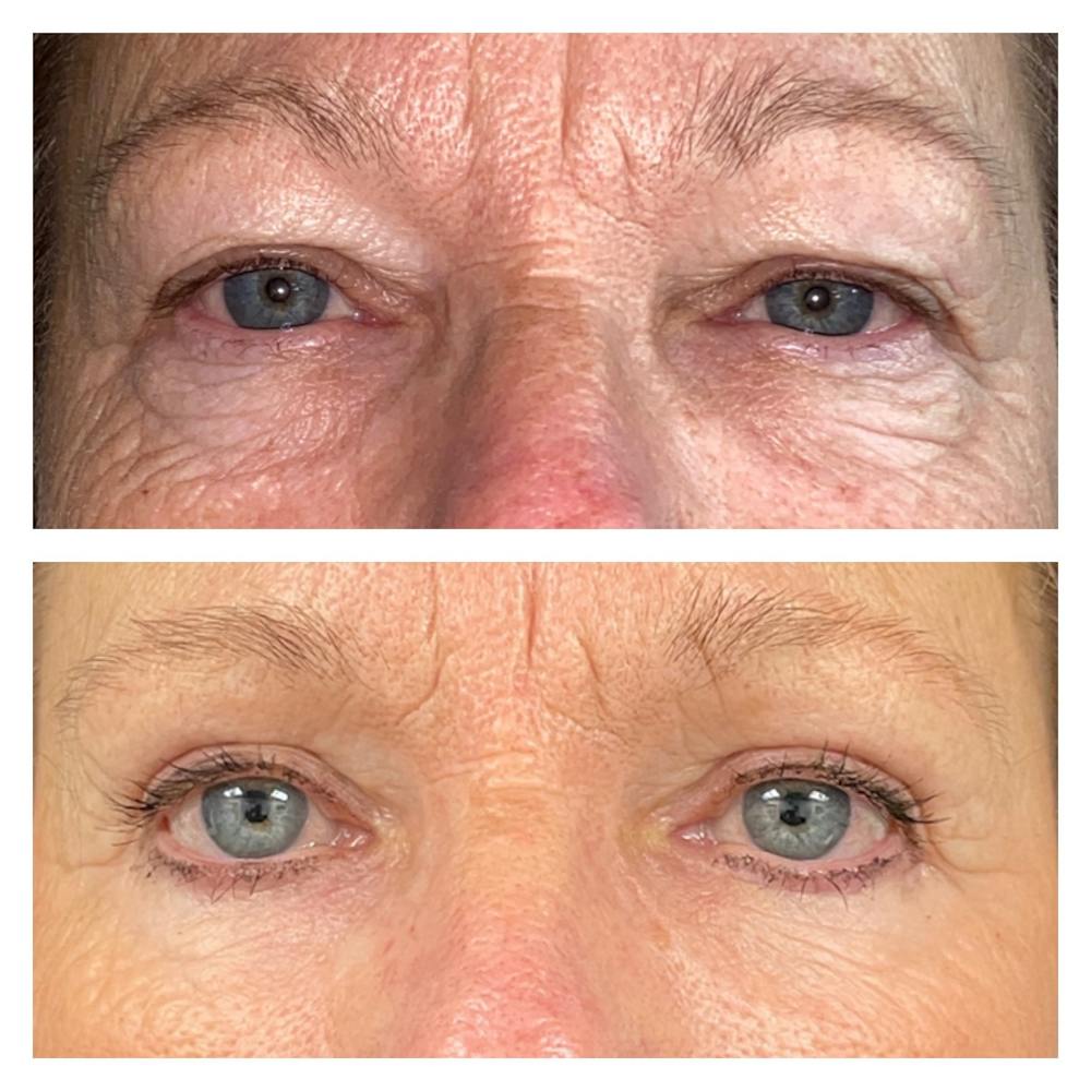 Laser Resurfacing Before & After Gallery - Patient 111639113 - Image 1