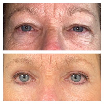 Upper Blepharoplasty Before & After Gallery - Patient 111639116 - Image 1