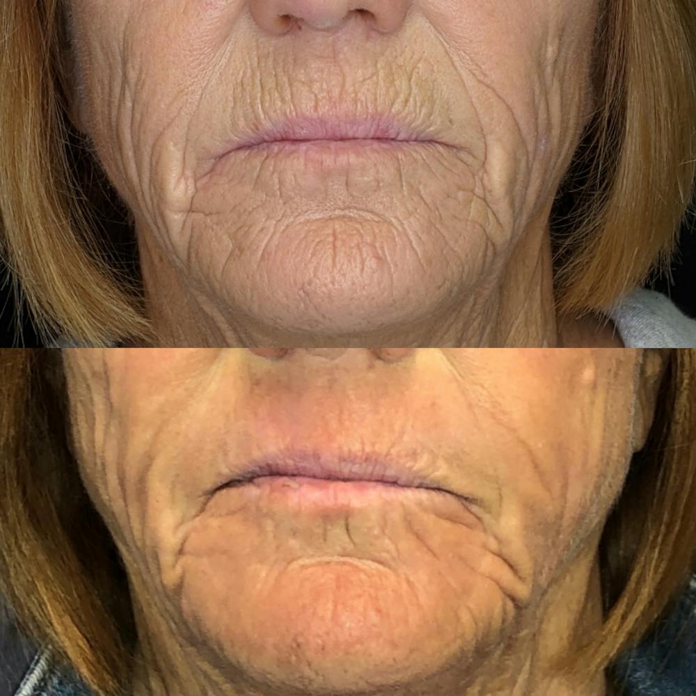 Laser Resurfacing Before & After Gallery - Patient 115308244 - Image 1