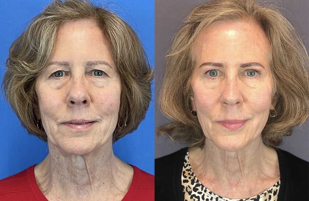 Upper Blepharoplasty Before & After Gallery - Patient 119930901 - Image 1