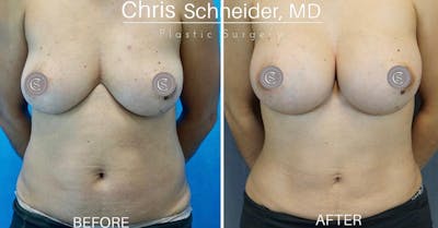Breast Augmentation Before & After Gallery - Patient 119934361 - Image 1