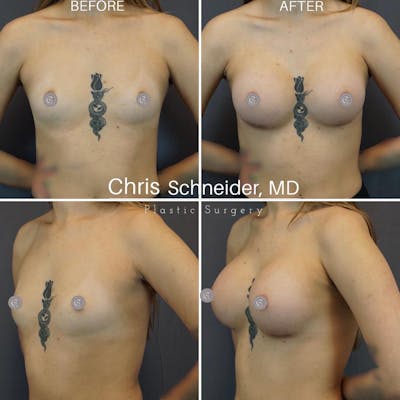Breast Augmentation Before & After Gallery - Patient 119934360 - Image 1