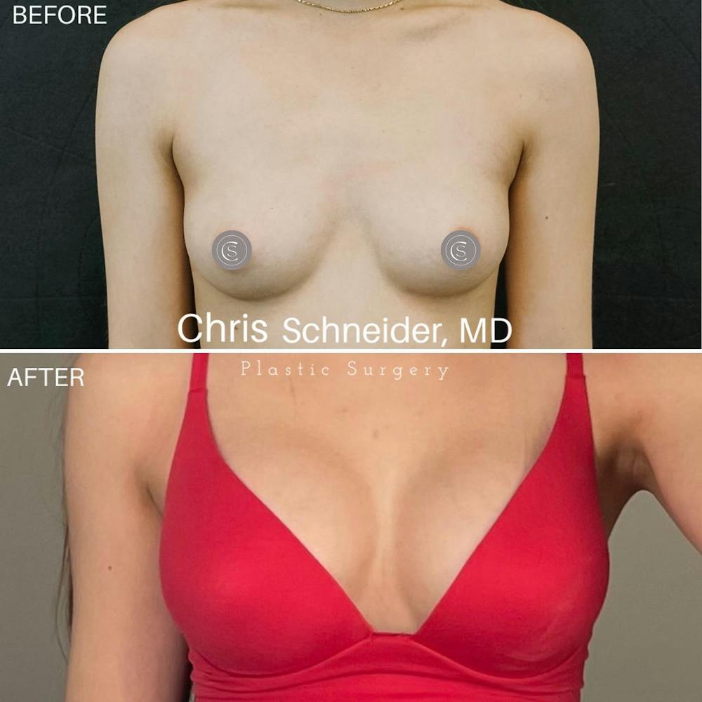 Breast Augmentation Before & After Gallery - Patient 119934536 - Image 1