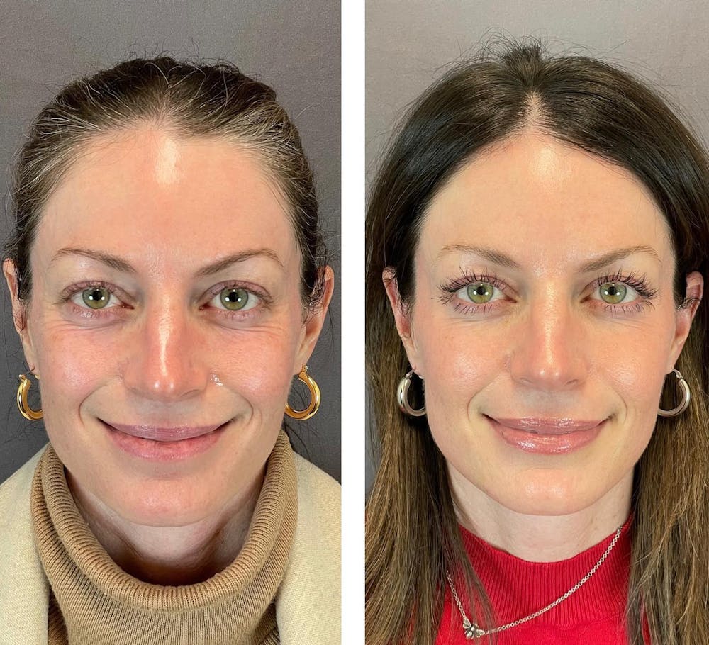 Dermal Fillers Before & After Gallery - Patient 119935090 - Image 2