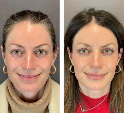 Dermal Fillers Before & After Gallery - Patient 119935090 - Image 2