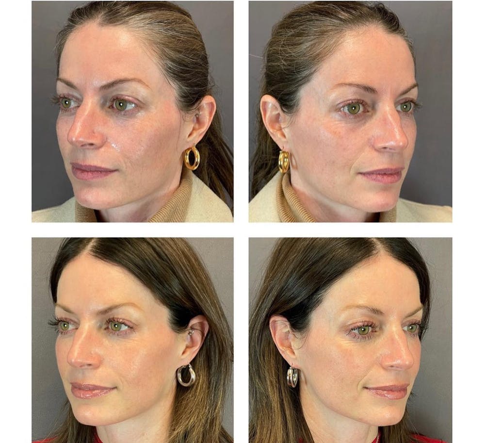 Dermal Fillers Before & After Gallery - Patient 119935090 - Image 3