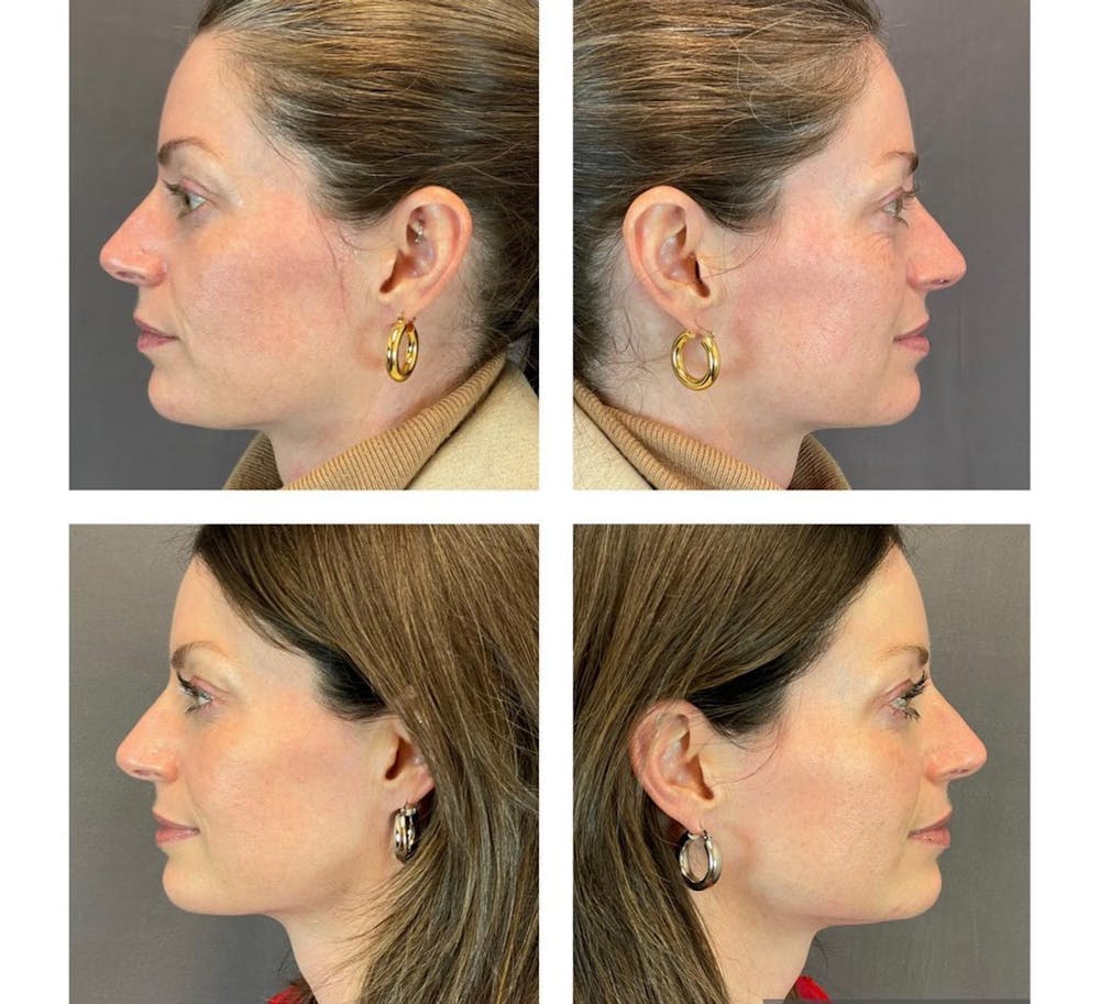 Dermal Fillers Before & After Gallery - Patient 119935090 - Image 4