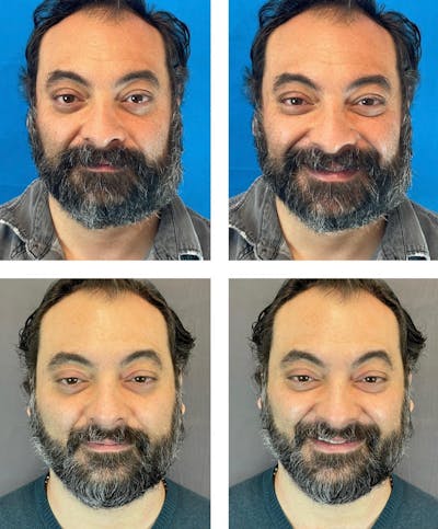 Lipoma Removal Before & After Gallery - Patient 119935121 - Image 1