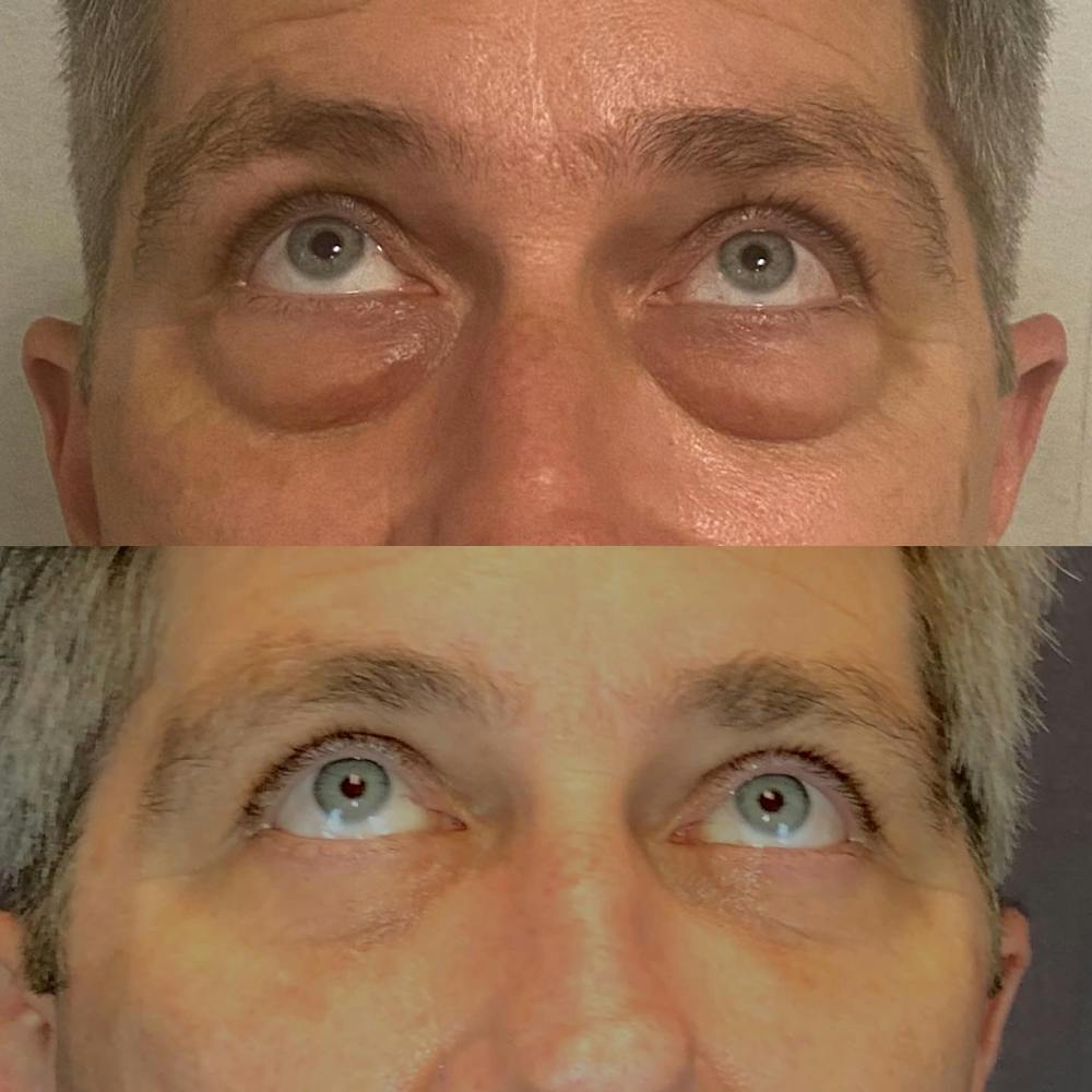 Lower Blepharoplasty Before & After Gallery - Patient 119935245 - Image 1