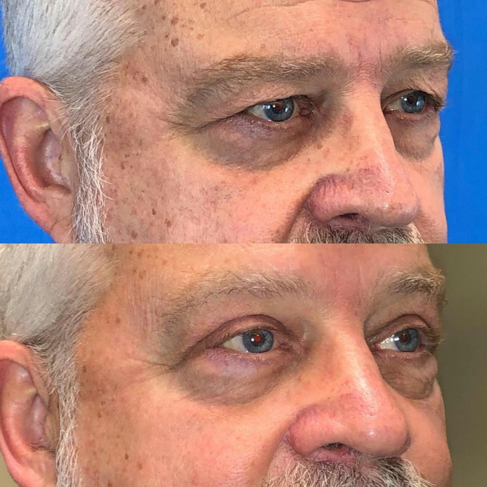 Upper Blepharoplasty Before & After Gallery - Patient 119935485 - Image 2